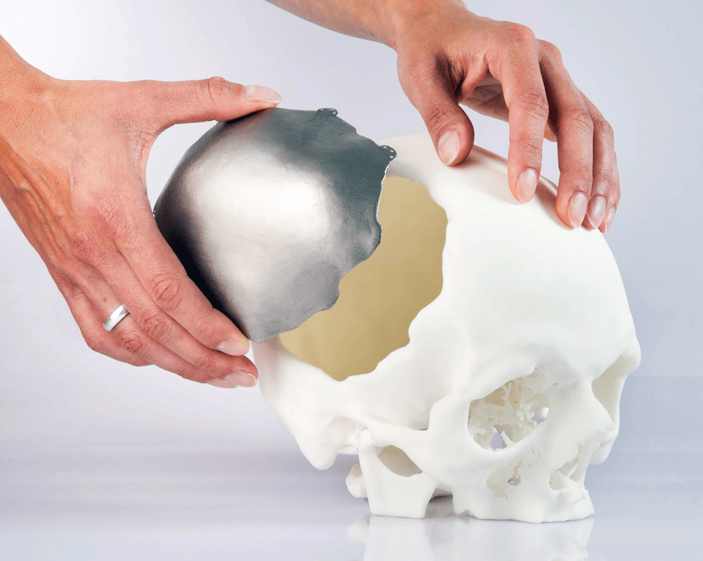 Patient Specific Implants